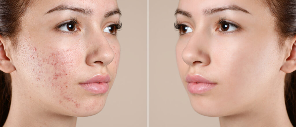 Acne Cure